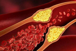 Как снизить холестерин без лекарств: советы врача